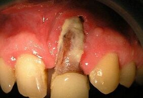 osteomyelitida po extrakci zubů